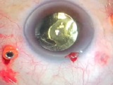 Combined Phaco-Vitrectomy