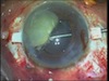 The IOL Scaffold Technique