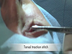 Laser Neocanaliculus DCR - A New Minimally Invasive Surgery for Canalicular Obstruction