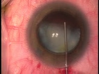 The Intumescent White Cataract and the Case of the Secret Foreign Body