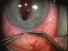 Fixation Out-of-the-Bag Dislocated IOL