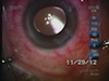 LenSx, CTR, ECP in the Management of Dislocated Cataract and Chronic Angle Closure