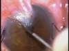 Pterygium Excision with Conjunctival Autograft