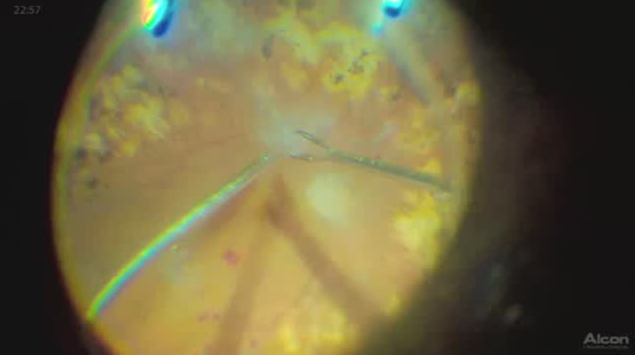 Surgery in an Eye With VMT, Diabetic Retinopathy [FLOREtina Live Surgery]
