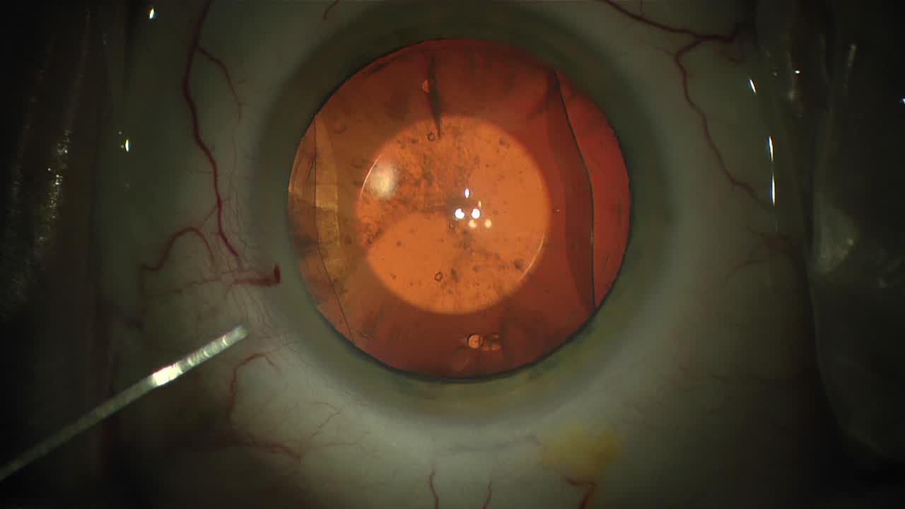 ICL Removal at Cataract Surgery