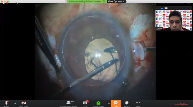 Webinar: Sutureless Scleral Fixation of IOL