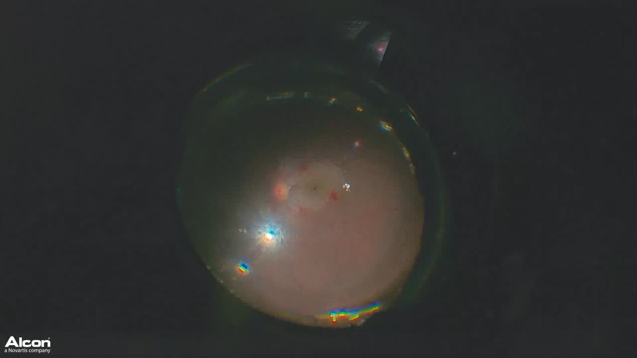 Choroidal Detachment