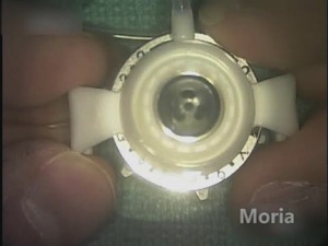 New Adjustable Corneal Trephine by Moria