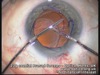 The Prodigal Haptic Eyetube - Good Surgery May Not Always Give Ideal Outcomes