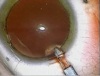 Posterior Lenticonus - Part 2