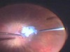 25-Gauge Vitrectomy for Retained Lens Fragments