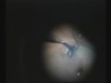 Shoelace Buckling with Vitrectomy and Sub-PFCL ILM Peeling for Retinal Detachment