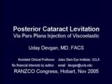 Posterior Cataract Levitation via Pars Plana Injection of Viscoelastic