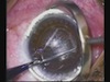 SMILE Procedure