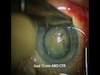 Early Vitrectomy and CTR Placement