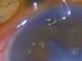 Safe and Effective Technique to Tackle Lens Induced Glaucoma in the Developing World