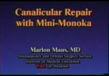 Canalicular Repair with the Mini-Monoka