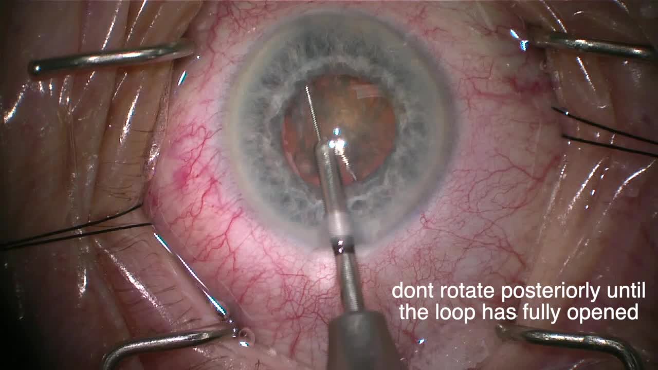 Use of the miLOOP in Pseudoexfoliation - Eyetube