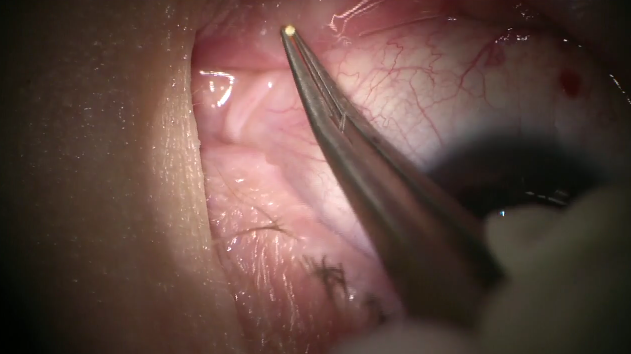 Dextenza Insertion: One-Motion Technique