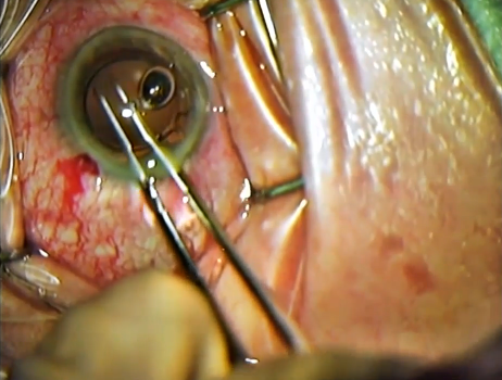 TASS After Cataract Surgery