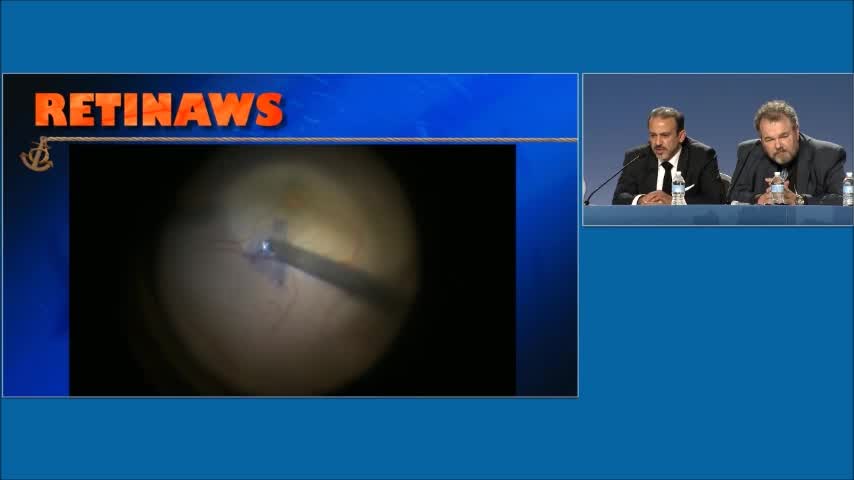 Macular Hole Sugery