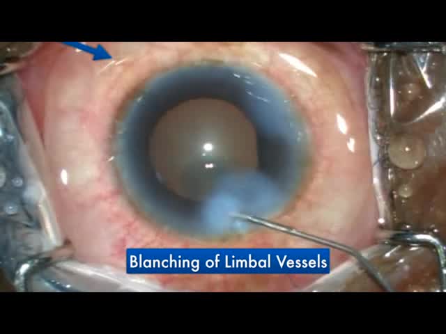 Can GATT be an Effective Surgical Option for POAG in Developing Countries?