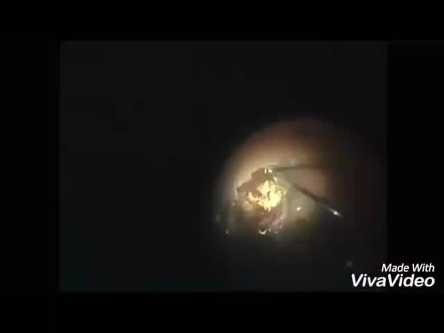 25G Melanoma Resection