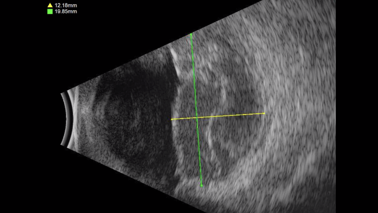 Subretinal Hemorrhage