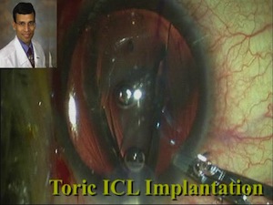 Pearls for Visian Toric Implantable Collamer Lens with CentraFLOW Technology