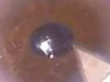 Retropupillary Enclavation