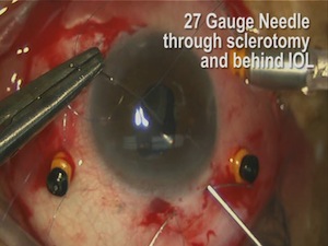 Trans-scleral 9-0 Prolene Fixation of In-the-Bag Dislocated PCIOL Cross-Swords Technique