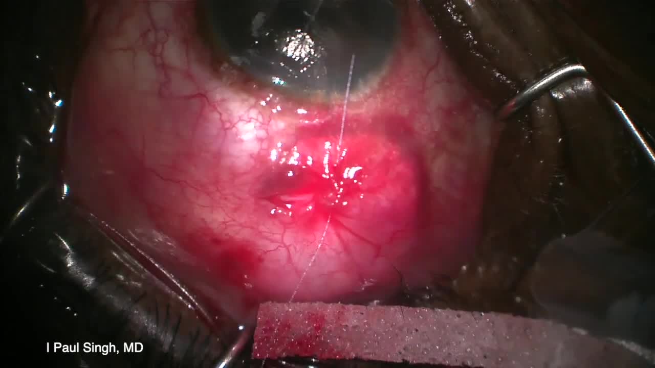 ClearPath Model 250 Implantation Small Incision Surgical Technique
