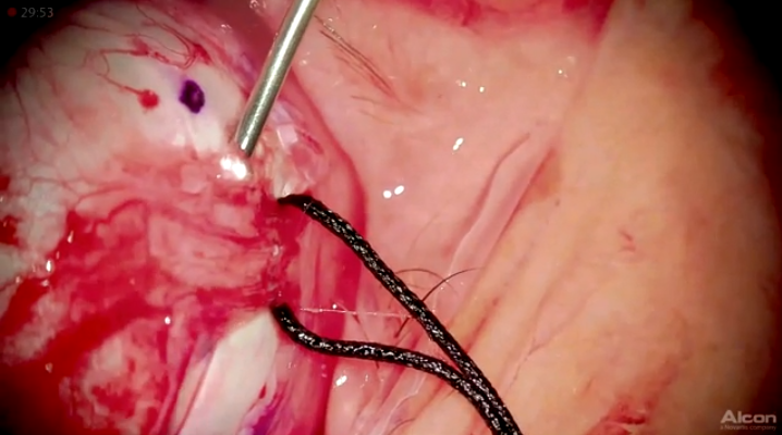 A Heads-Up Suprachoroidal Chandelier Scleral Buckle