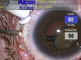 Subluxated Lens