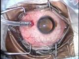 Giant Retinal Tear Repair with Alcon 23g Pars Plana Vitrectomy
