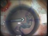 Multifocal Glued IOL