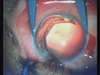 Artificial Iris implanation and IOL Suture