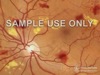 Diabetic Retinopathy - Animated Patient Education
