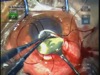 ICCE in Anteriorly Dislocated Crystalline Lens