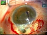 Hypotony Filtration Revision