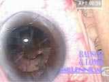 25 gauge Anterior Vitrectomy via the Pars Plana for Posterior Capsule Rupture