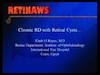 Chronic RD with Retinal Cysts