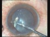 Traumatic Cataract with IOFB - 2 Cases
