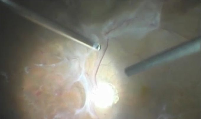 25-Gauge Vitrectomy for the Treatment of Complicated Diabetic Tractional Retinal Detachment