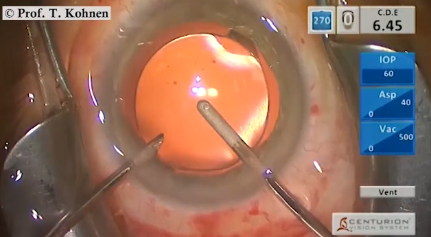 Laser-Assisted Cataract and Refractive Lens Surgery 