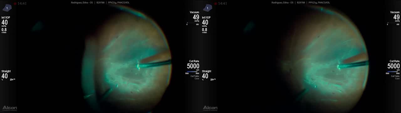 Tractional and Rhegmatogenous Retinal Detachment
