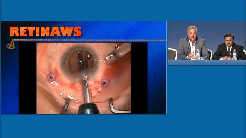 Trochar Insertion