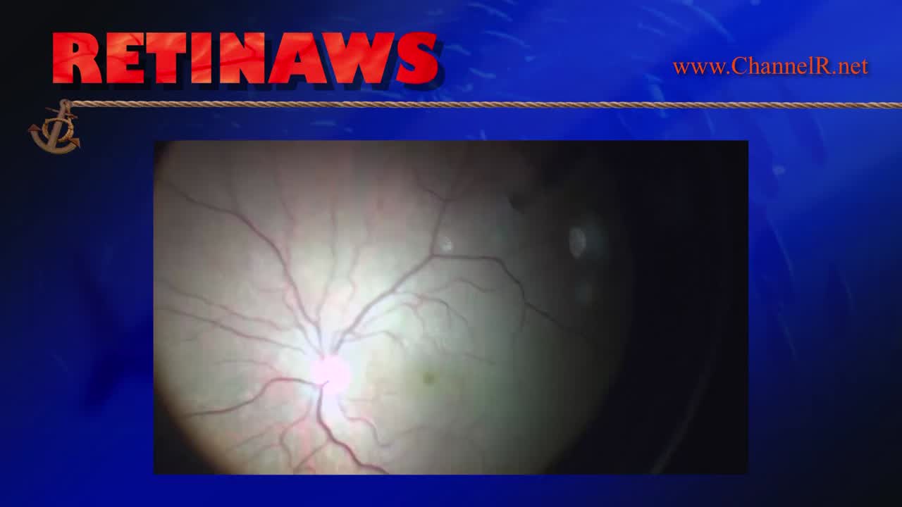 Chronic Macular Hole