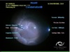 Traumatic Retinal Detachment and the New Edgeplus Valved Entry System