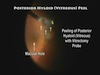  Vitrectomy with Internal Limiting Membrane Peel for Idiopathic Macular Hole 